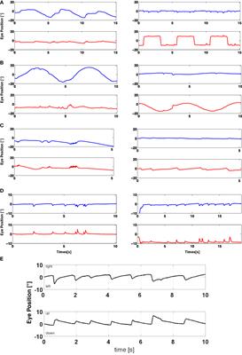 Oculomotor and Vestibular Findings in Gaucher Disease Type 3 and Their Correlation with Neurological Findings